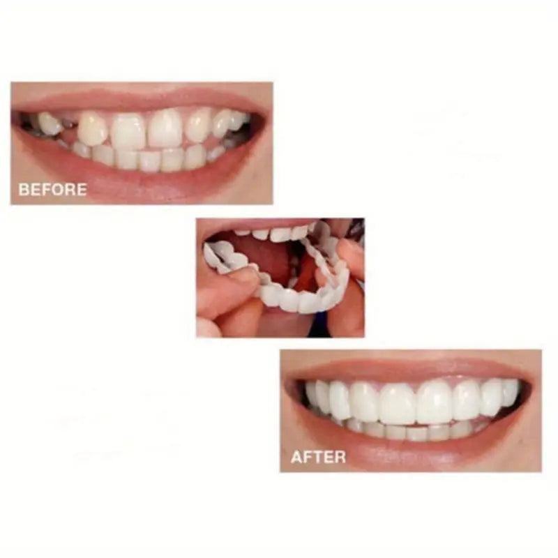 Pair of Snap-On Teeth Covers – Natural Look, Instant Smile